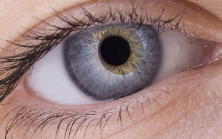 Génmutáció okozhatja a szem-melanomát 