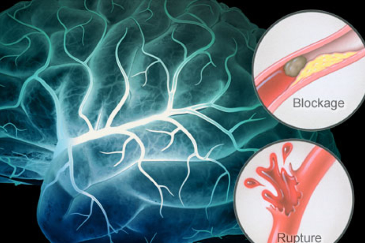 A tinédzserkori élet befolyásolja a stroke kockázatát