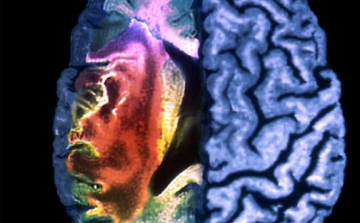 Agyvérzésre és szívrohamra hajlamosító génhibát fedeztek fel angol kutatók